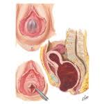 Imperforate Hymen