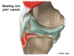 http://www.eorthopod.com/sites/default/files/images/knee_acl_diagnosis01.jpg