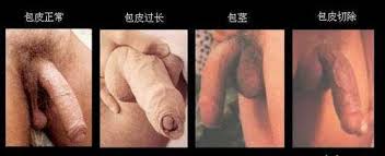 性包茎。