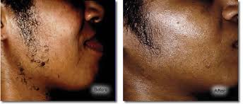 A: Hair removal can be