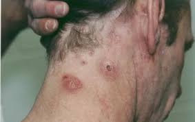 Remember that these  infections 