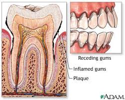  Gingivitis 