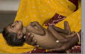 http://lucastmiller.files.wordpress.com/2008/03/malnutrition-unicef-india.jpg