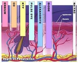 Laser Hair Removal.