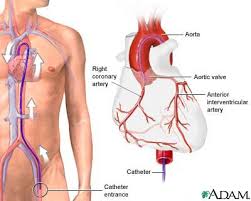 Coronary  angiography  