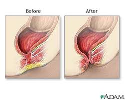 Imperforate anus repair -
