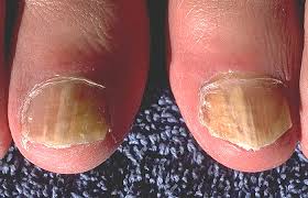 http://fromyourdoctor.com/ext/fungal_nail_infection.jpg
