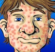http://i1043.photobucket.com/albums/b433/Limaro_album/acne.png
