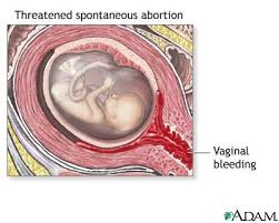an  incomplete abortion  may
