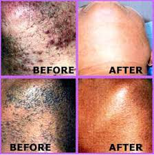 All About Laser Hair Removal