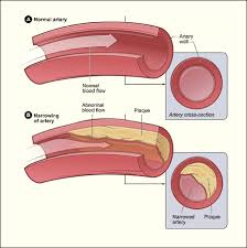 Figure B shows an artery with