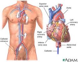  stent placement  -  heart 