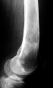 http://www.sarctrials.org/upload/chondroxray_93095.jpg