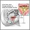  Acute bilateral obstructive 