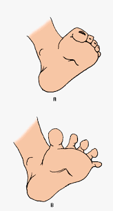  Babinski reflex : A normal