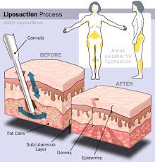 safety of liposuction