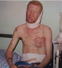 Vaccine For Skin Cancer