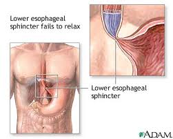  Achalasia  - series