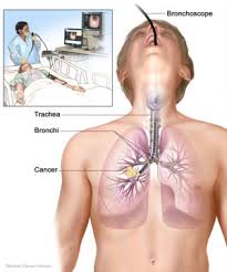   Bronchoscopy   is a medical procedure    