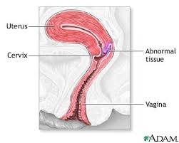  Cervical dysplasia  - series
