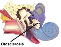 http://www.ent.com.hk/t_chi/images/diagnosis/ear/otosclerosis.jpg