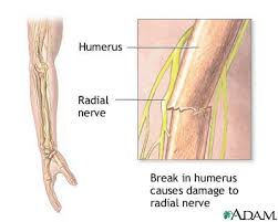Radial nerve dysfunction - via Daymix