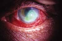 http://www.amokeratitislawyer.com/images/keratitis.jpg