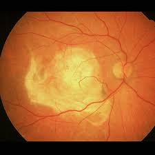  Macular  Exudates/Dry
