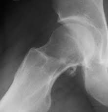 http://bonetumor.org/images/jxccxraylatpreop.jpg