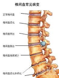 病变，属中医“腰腿痛”范畴。