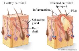 http://healthproductsreviewed.org/images/acne/acne-vulgaris.jpg