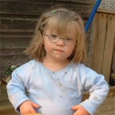 A child with Down's syndrome - via Daymix