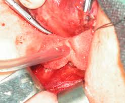control using HPA tampon,