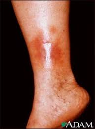  Stasis dermatitis  and  ulcers 