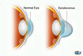  keratoconus 