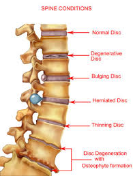  Low back pain  is the most