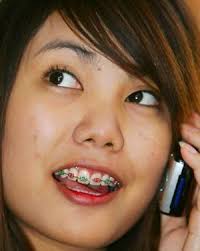 Clear Braces - Get braces on