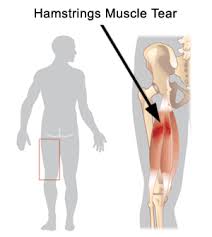 Hamstring  Strains 