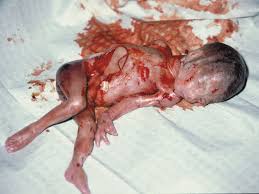 Reasons Women Choose  Abortion 