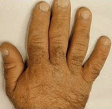  Acromegaly 