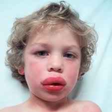 http://optimistworld.com/files/anaphylaxis%2520230x230.jpg