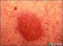 Dermatitis,  pustular  contact
