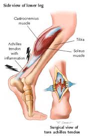  achilles tendonitis 