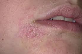  Eczema  - Oral