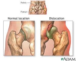 A  dislocation  is an injury in