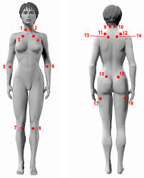 fibromyalgia