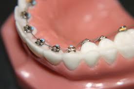 STb LINGUAL BRACES (8TH