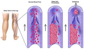   deep vein thrombosis  