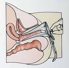      Speculum inserted into  vagina   