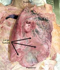 presence of  lung cancer .